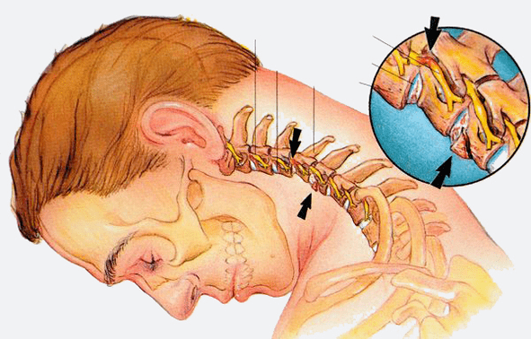 The level of osteochondrosis of the cervical spine